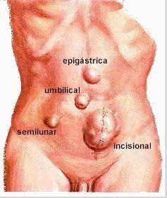 Tipos de Hernias